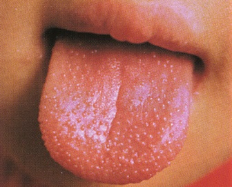 イチゴ舌